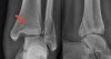 icd 10 lateral malleolus fracture