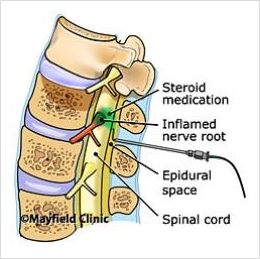 Sciatic nerve damage from steroid injection